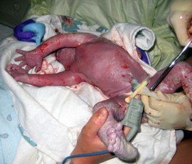Profissionais coletam o sangue do cordão umbilical de um bebê segundos após seu nascimento.